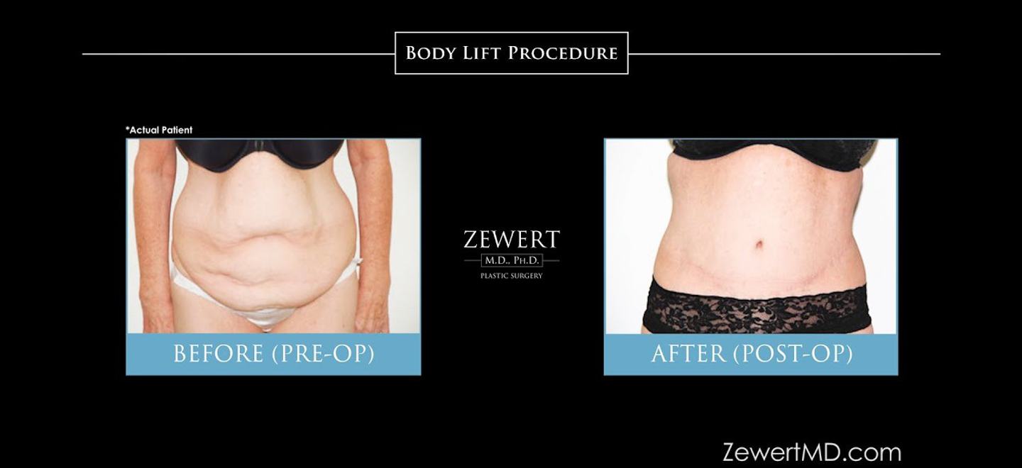 Body Lift