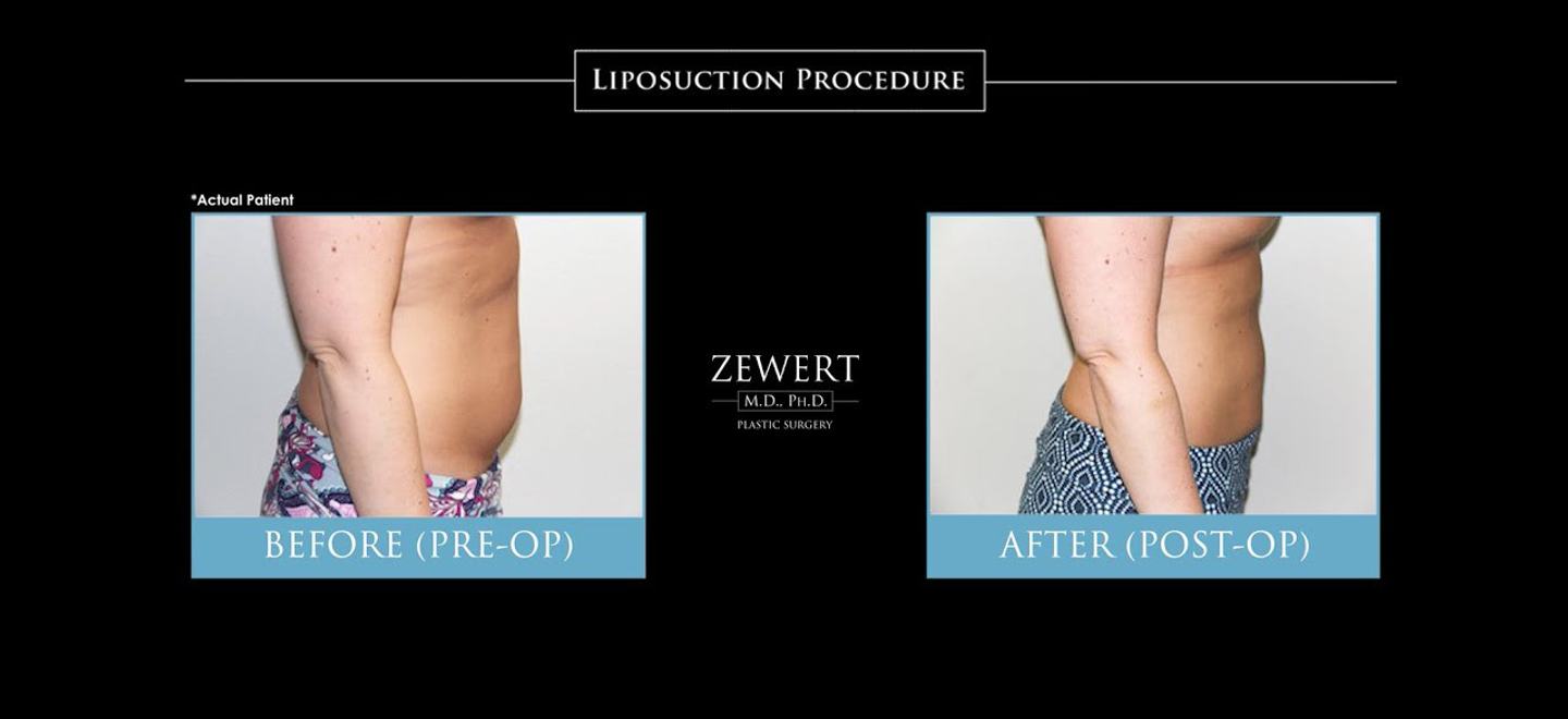 Liposuction