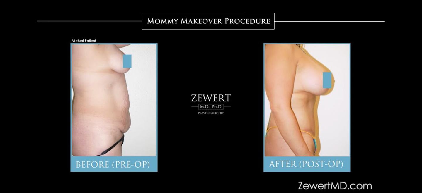 Mommy Makeover