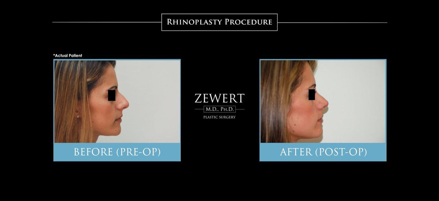 Rhinoplasty