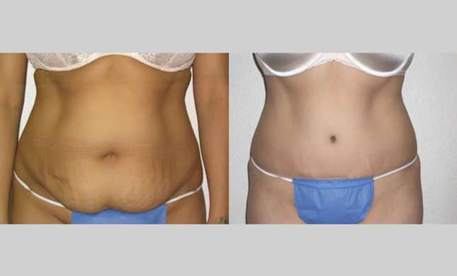 Tummy Tuck: Image #100