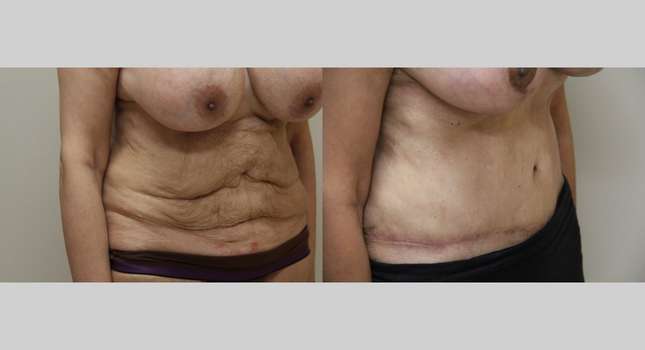 Tummy Tuck: Image #1000
