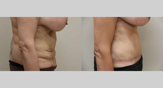 Tummy Tuck: Image #1001