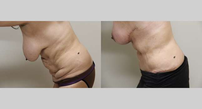 Tummy Tuck: Image #1002