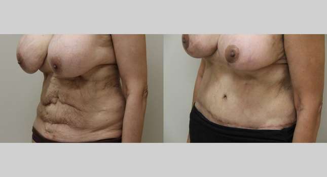 Tummy Tuck: Image #1003
