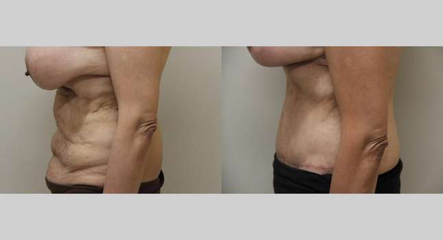Tummy Tuck: Image #1004