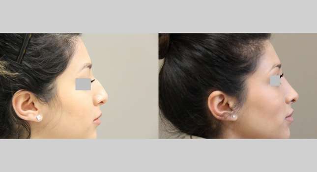 Nose Surgery: Image #1006