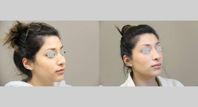 Nose Surgery: Image #1007