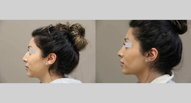Nose Surgery: Image #1008