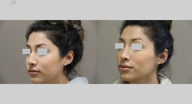 Nose Surgery: Image #1009