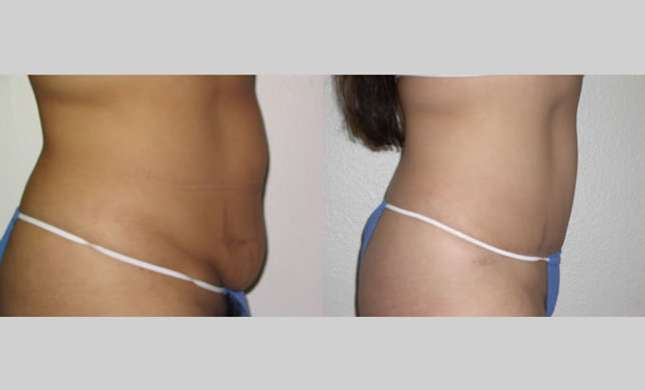 Tummy Tuck: Image #101