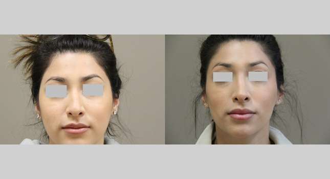 Nose Surgery: Image #1010