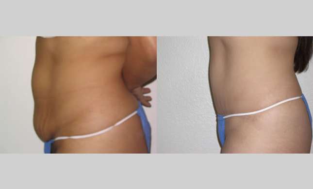 Tummy Tuck: Image #102