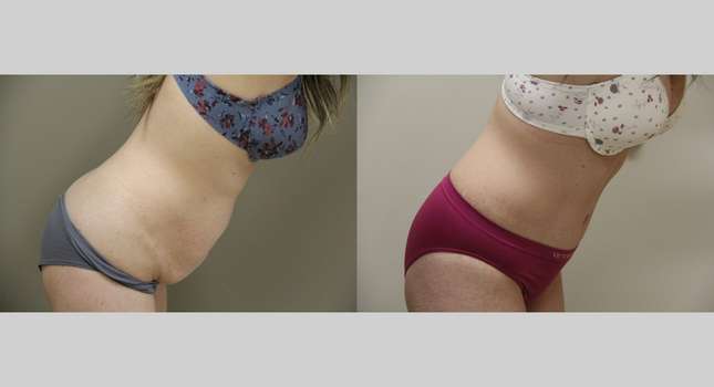 Tummy Tuck: Image #1026