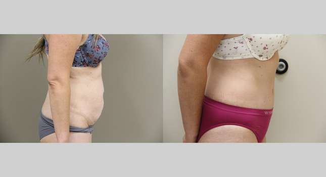 Tummy Tuck: Image #1027
