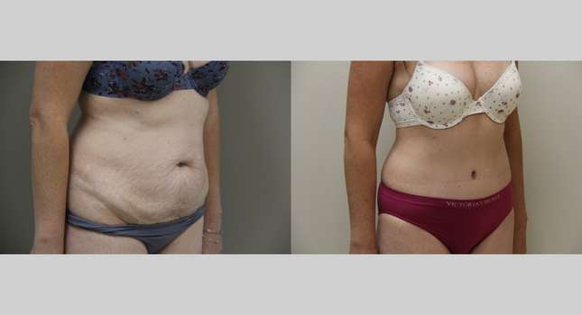 Tummy Tuck: Image #1028