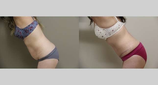 Tummy Tuck: Image #1029