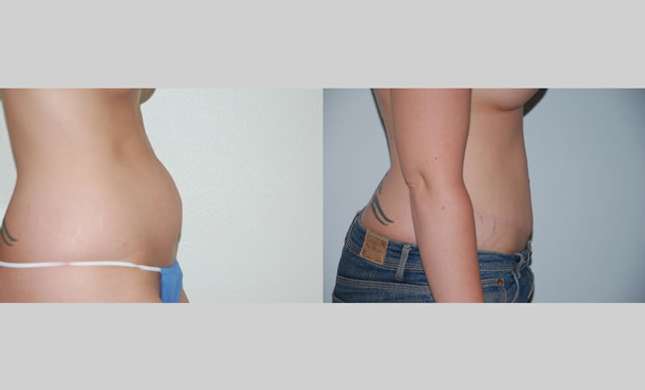 Tummy Tuck: Image #103
