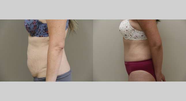 Tummy Tuck: Image #1030