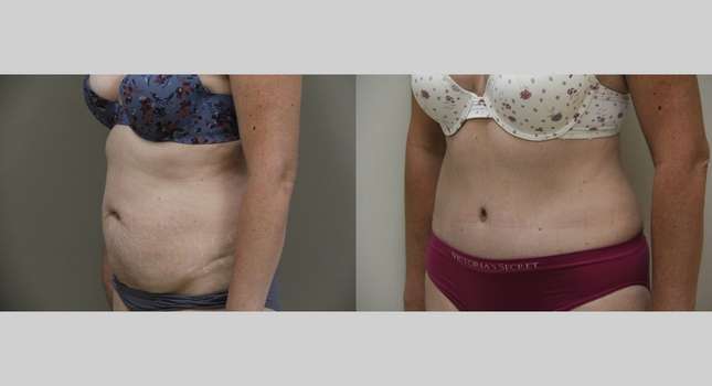 Tummy Tuck: Image #1031