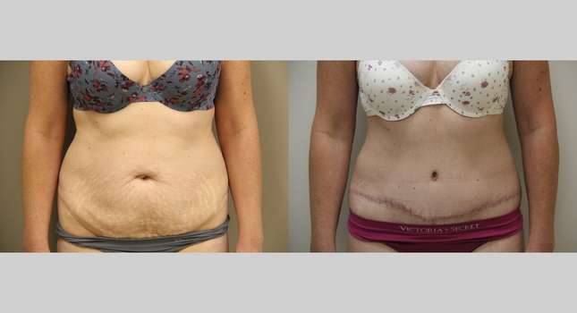 Tummy Tuck: Image #1032