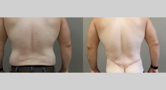 Body Lift: Image #1033