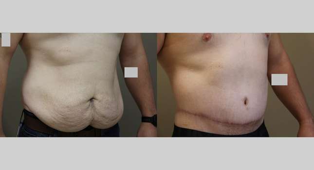 Body Lift: Image #1036