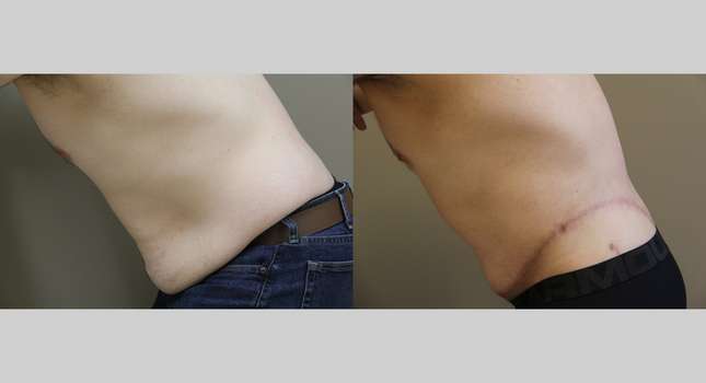 Body Lift: Image #1037