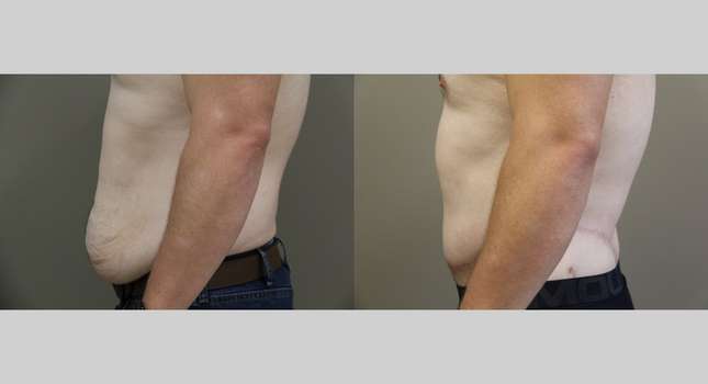 Body Lift: Image #1038