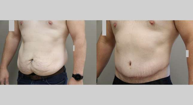 Body Lift: Image #1039