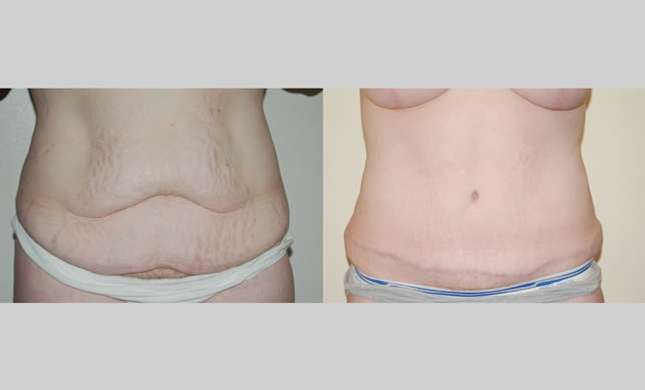 Tummy Tuck: Image #104