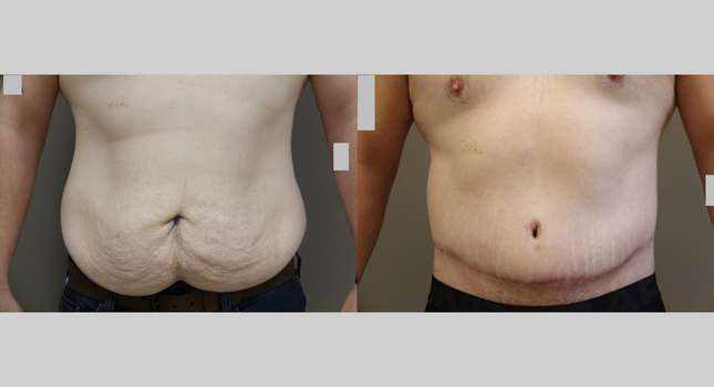 Body Lift: Image #1040