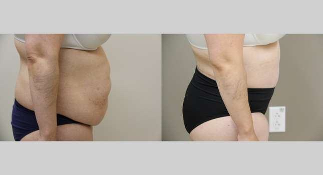 Body Lift: Image #1041