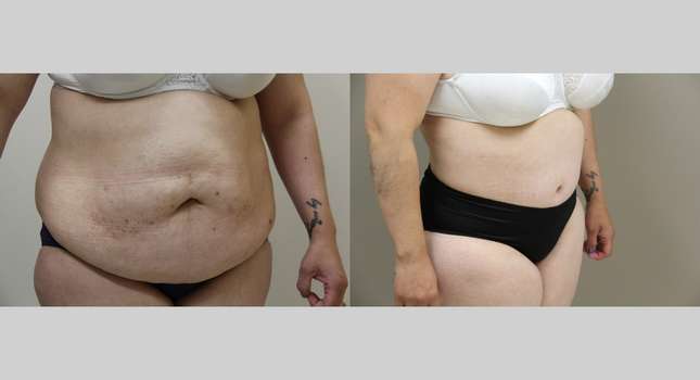 Body Lift: Image #1042
