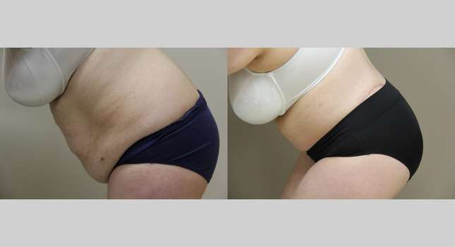 Body Lift: Image #1043