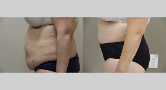 Body Lift: Image #1044
