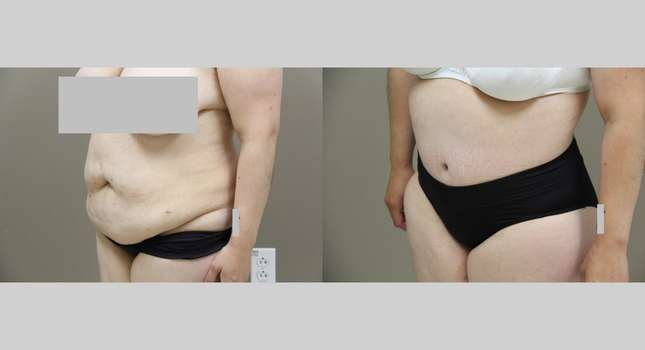 Body Lift: Image #1045