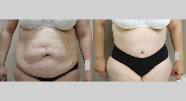 Body Lift: Image #1046