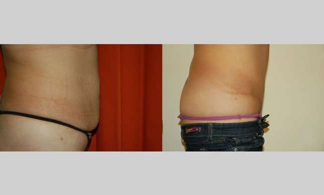 Tummy Tuck: Image #105