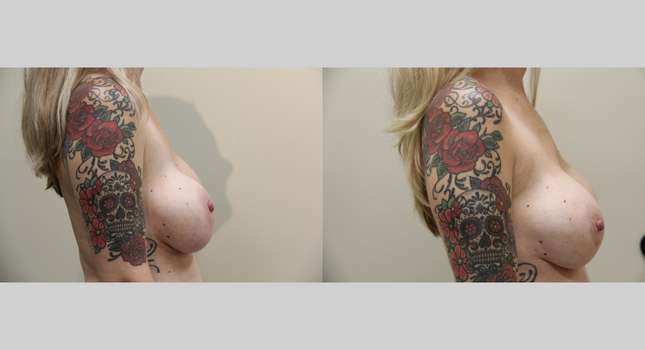 Breast Reconstruction: Image #1057