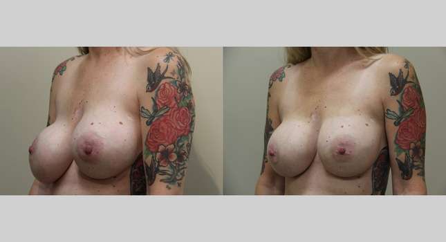 Breast Reconstruction: Image #1059