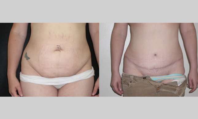 Tummy Tuck: Image #106