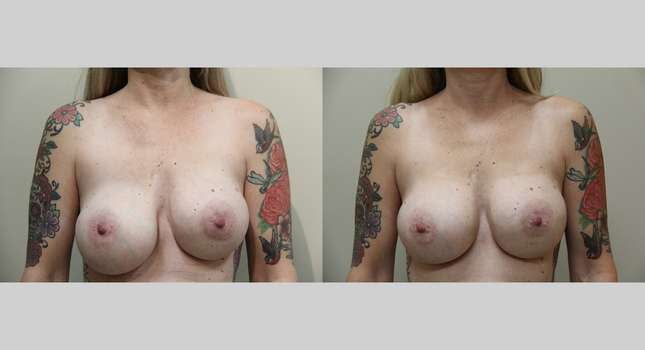 Breast Reconstruction: Image #1060