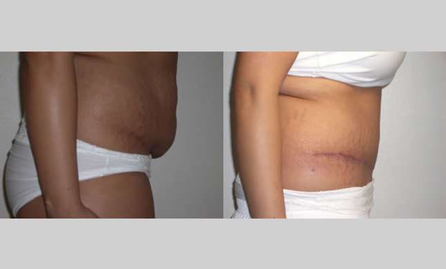 Tummy Tuck: Image #107
