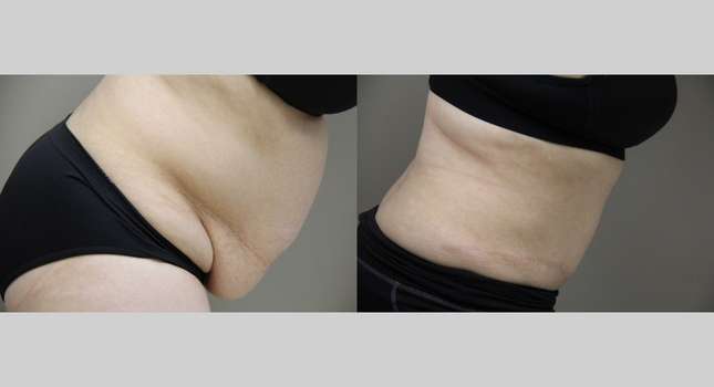 Tummy Tuck: Image #1071