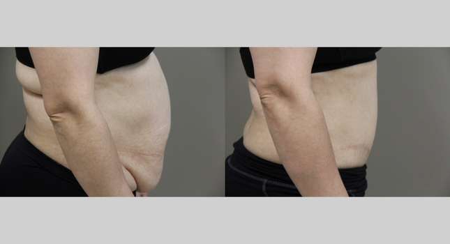 Tummy Tuck: Image #1072