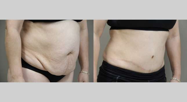 Tummy Tuck: Image #1073