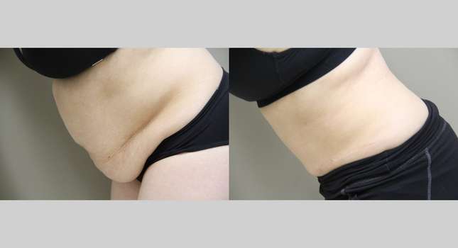 Tummy Tuck: Image #1074