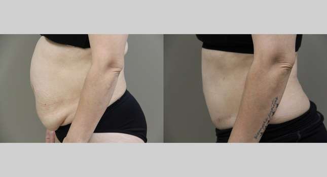 Tummy Tuck: Image #1075