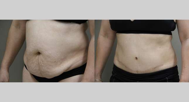 Tummy Tuck: Image #1076